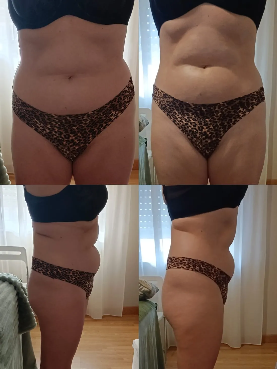 Resultado real de Drenaje Brasileño · Trabajo en abdomen y cintura